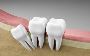 Top 5 Myths About Wisdom Tooth Extraction Debunked