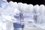 Dental Implants: Are They Right for You?