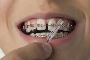 Braces Off! What Happens After Treatment?