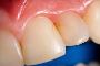 How to Ease Pain After Root Canal Treatment?