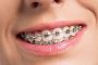 Are braces treatment a good option for teenagers?