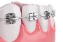 Tips to Stay Comfortable During Braces Treatment