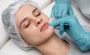 Discover the Best Dermal Fillers for Smile Lines