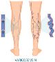 Critical Limb Ischemia: How Early Detection Can Save Your Li