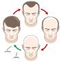 Say Goodbye to Hair Loss – Expert FUE Hair Transplants in UK