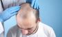 Hair Looking Thin? Try FUE Hair Transplant – Book Today!