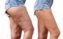 Truth About Cellulite