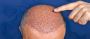 Top Hair Transplant Clinics in Bangalore 