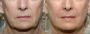 Advanced Tissue and Skin Tightening Treatment in Bangalore