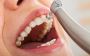Teeth Cleaning at Whalom Dental