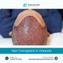 Best Hair Transplant in Orlando – Restore Your Confidence