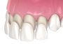 Durable & Natural-Looking Dental Implants Gordon