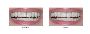 Best Dental Crowns Treatment in Berwick - Woodleigh waters d