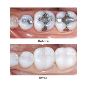 Best Inlays and Onlays Treatment in Berwick by Woodleighwate