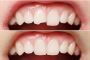 Dental Bonding Berwick - Woodleigh waters dental surgery