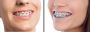 Conventional Braces Treatment Berwick - Woodleigh Waters Den