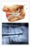 Wisdom Teeth Removal Berwick - Woodleigh Waters Dental Surge