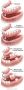 Restore Optimal Teeth Structure & Function Through Dentures