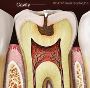 Learn How Dental Fillings Protect Your Teeth 