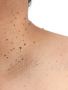 Expert Skin Treatment MK | Safe & Effective Results