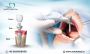 Best Dental Implant Treatment in Sarjapur Road Bangalore: Ze