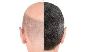 Hair Transplant in Dubai