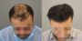 Hair Transplant in Abu Dhabi